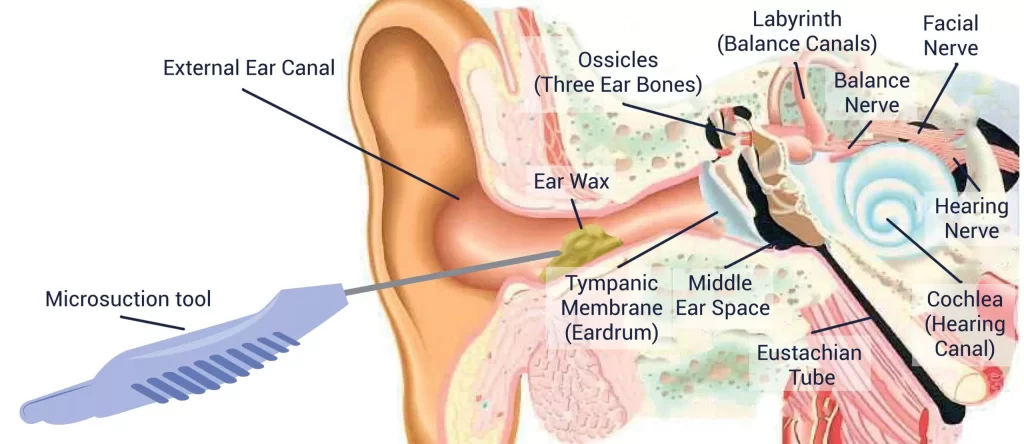 Earwax-removal-Weymouth-Dorchester-Microsuction-Home-mobile-visits